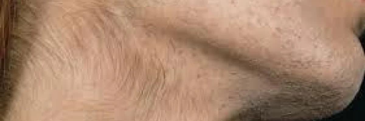 Görünümü erkekleşen kadınlar (hirsutismus-kadında tüylenme artışı)