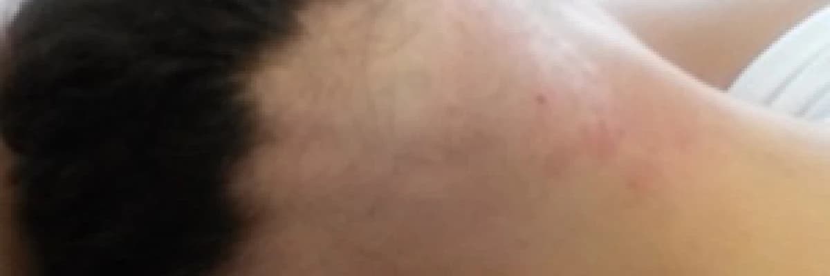 Saç dökülmesi ve tedavisi