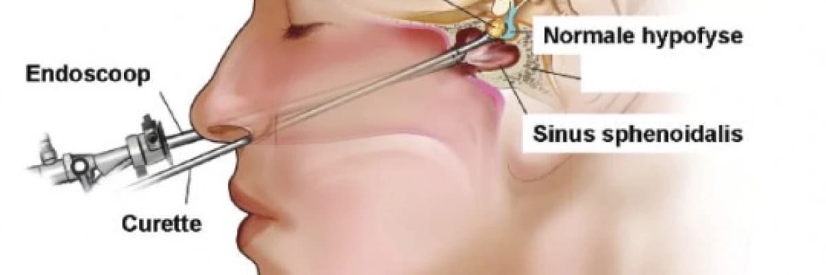 Hipofiz adenomu nedir? Tedavisi nasıl yapılır?