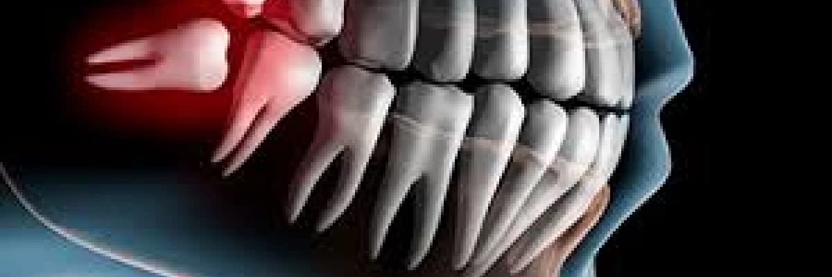 Gömülü diş nedir?