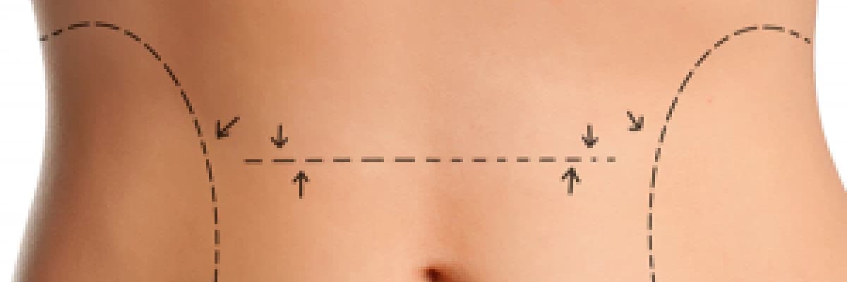 Karın germe (abdominoplasti) ve sonrası