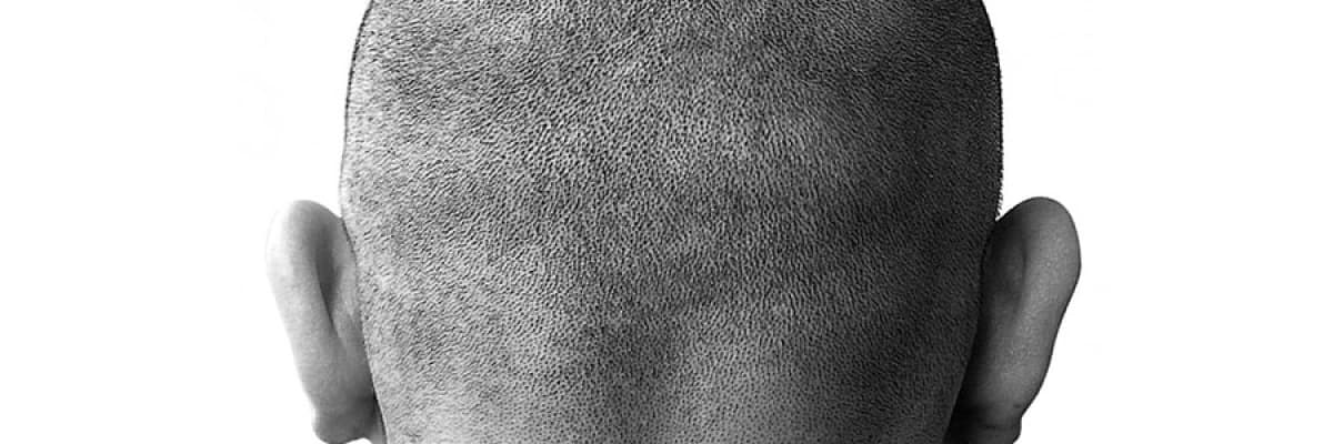 Fue (foliküler ünite extraksiyonu) saç ekim yöntemi