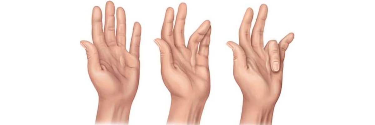 Dupuytren kontraktörü nedir?