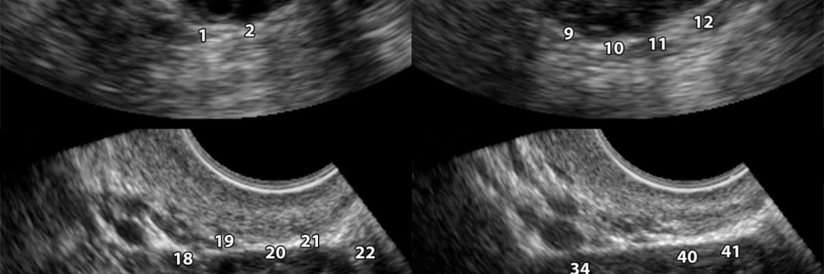 Polikistik over sendromu ( pcos)