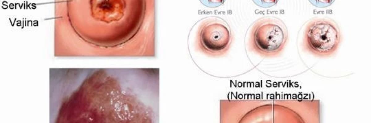 Yara dondurma ve yakma