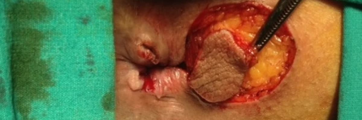 Rektum kanseri, tanı ve tedavisi