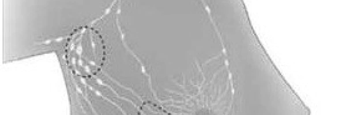 Meme kanserini tedavi seçenekleri