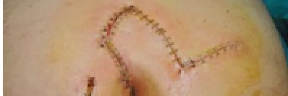 Pilonidal sinüs (kıl dönmesi) ve cerrahi tedavisi