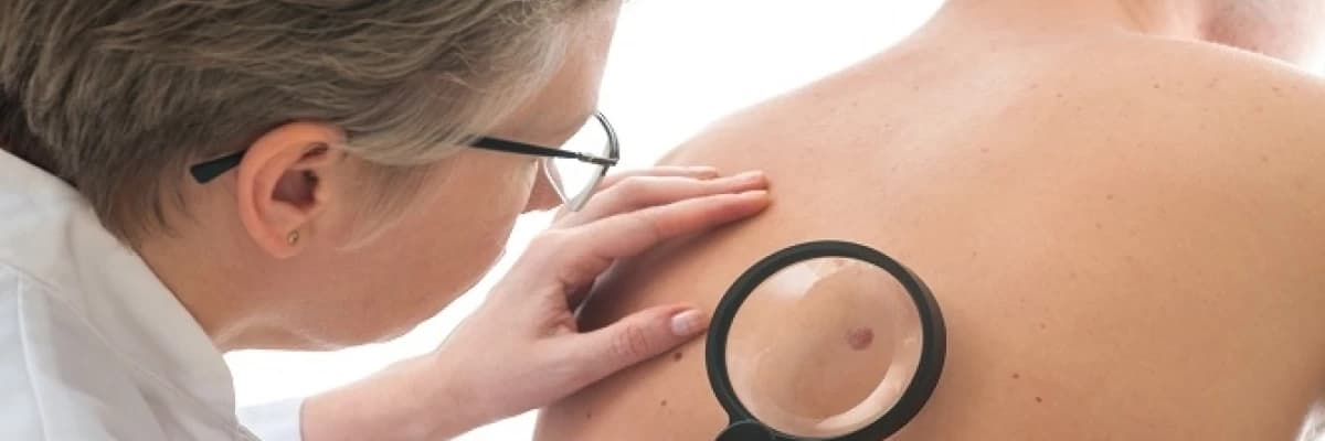 Derinin iyi huylu tümörleri