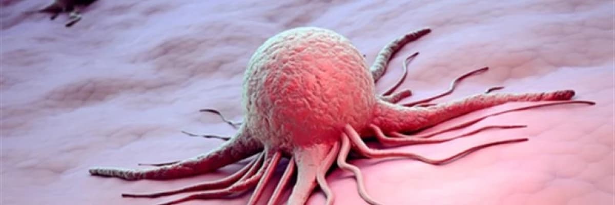 Ben kanseri ( malign melanom )