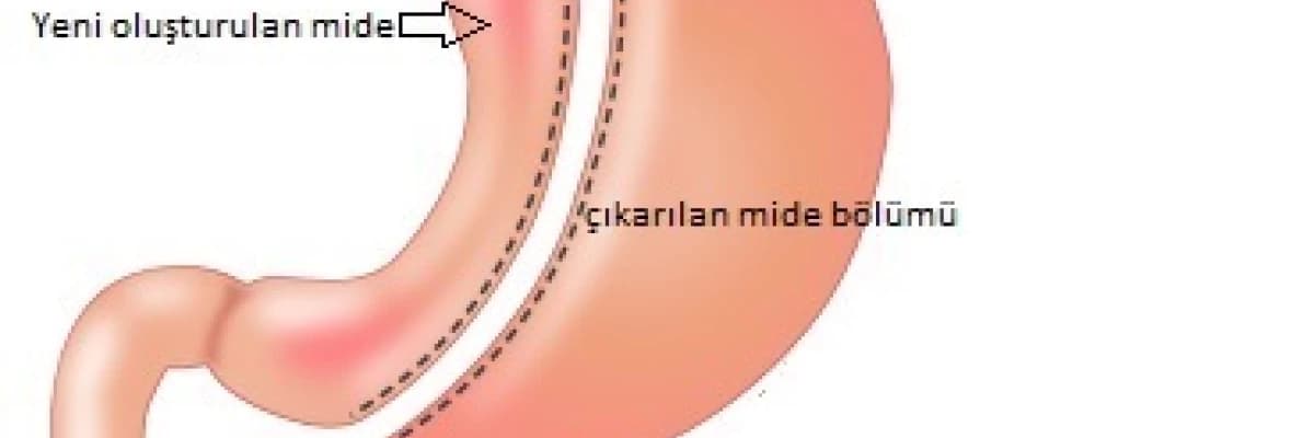 ŞİŞMANLIK TEDAVİSİ