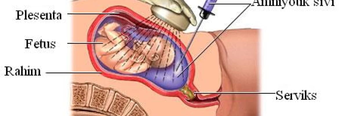 Amniyosentez (Amniosentez) nedir ? Neden yapılmalıdır?
