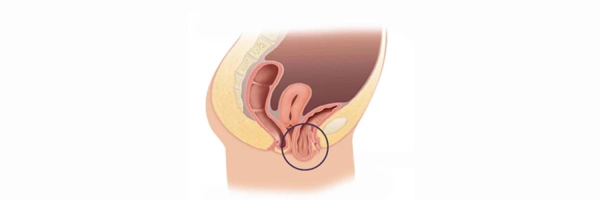İdrar torbası sarkması (Sistosel)