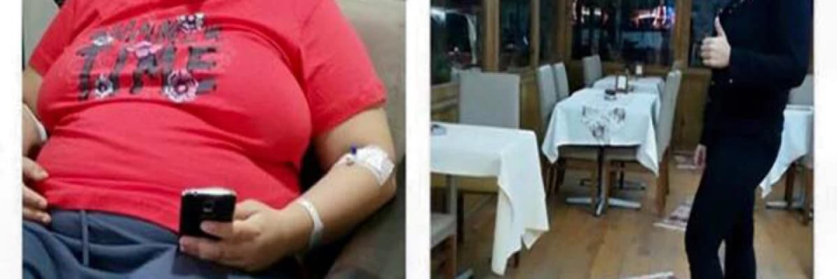 Gastrik By-Pass Sonrası Püre-Katı Beslenme