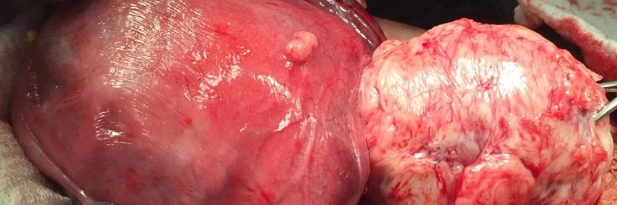 MYOM (RAHİMDE UR) TAKİBİ ÖNEMLİDİR.