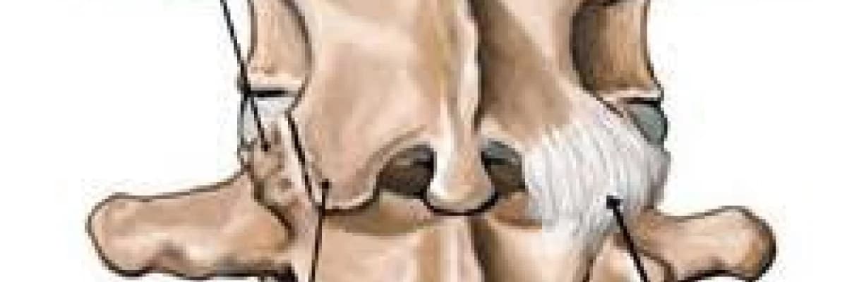 priformis sendromu bel fıtıgı ile karıştıralabilir.