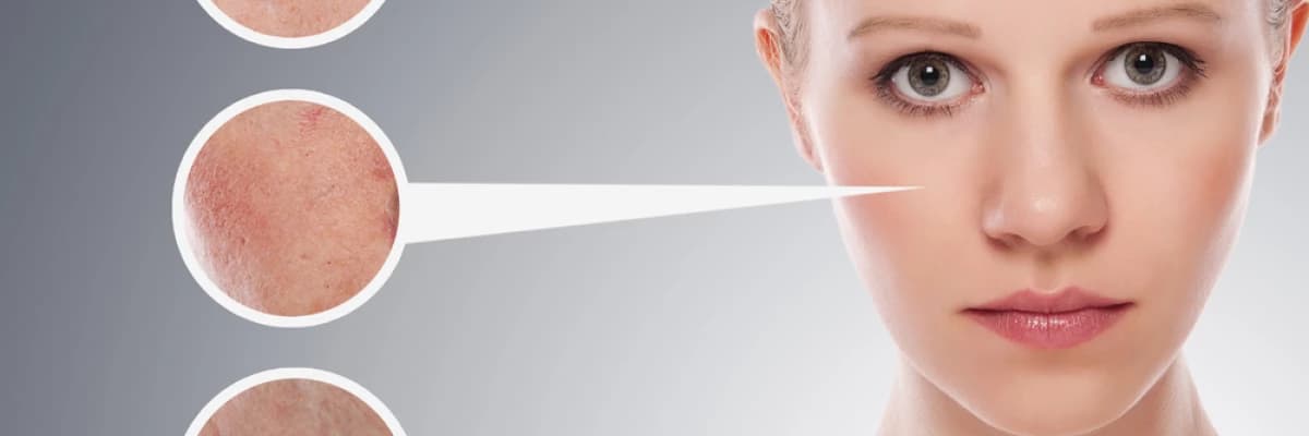 Leke tedavisi ne zaman yapılır?