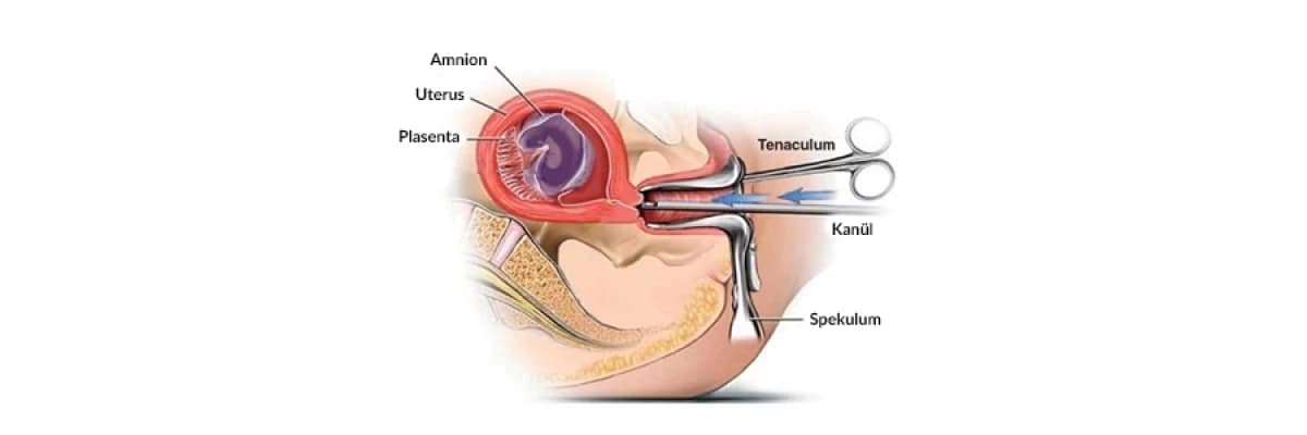 Kürtaj nedir? Kürtaj nasıl yapılır?