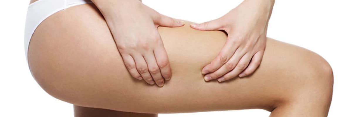 Selülit Nasıl Oluşur? Korunma Yolları Nelerdir?