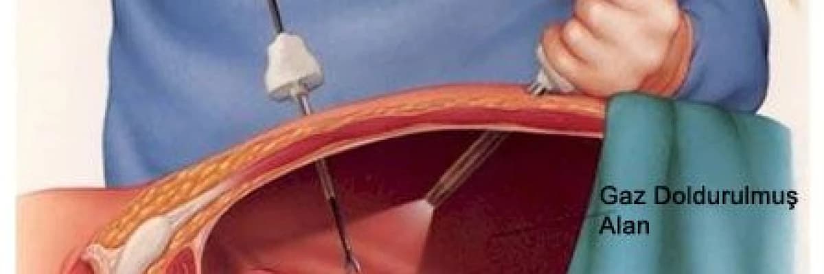 Laparoskopi Nedir? Laparoskopik Uygulamalar Nelerdir?