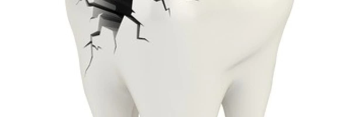 Diş Çürüğü Nedir? Etkenleri Nelerdir?