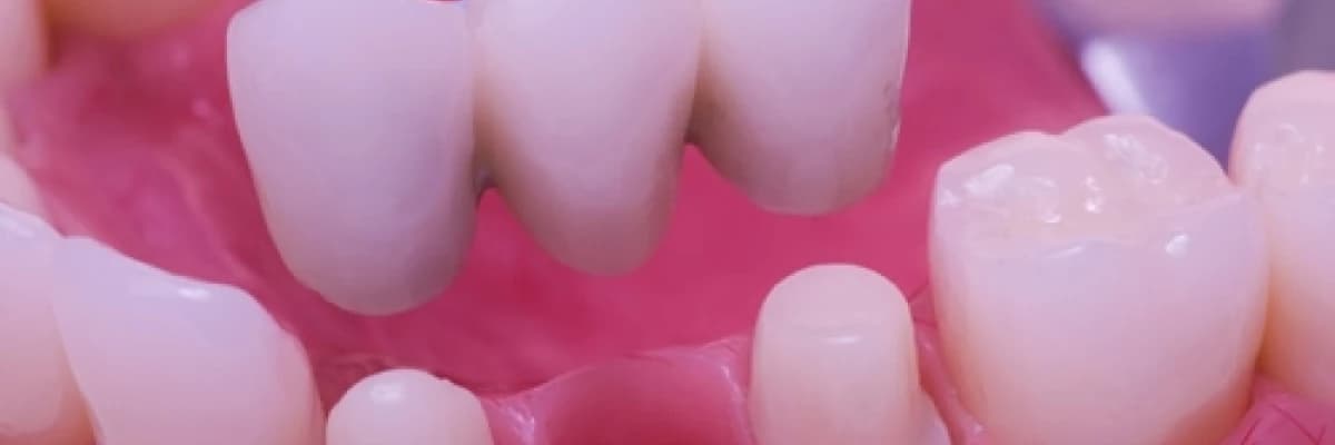 Zirkonyum Protez Nedir? Nasıl Yapılır?