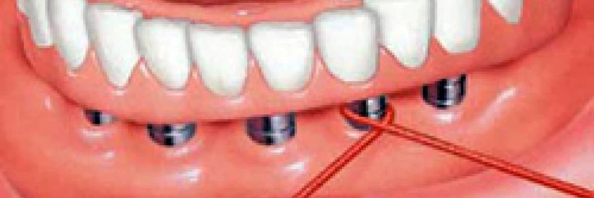 İmplant bakımı nasıl olmalıdır?