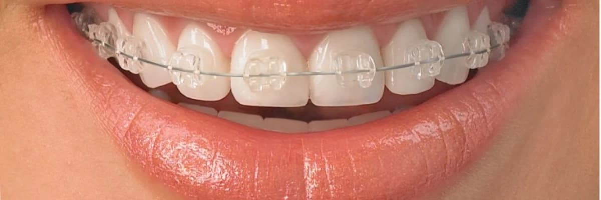 Ortodonti; Kişi ortodontik bozukluk olduğunu ilk ne zaman anlar?