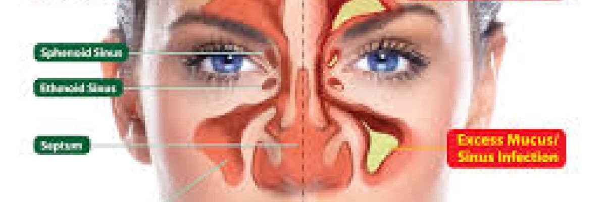 Sinüzit ve Tedavisi