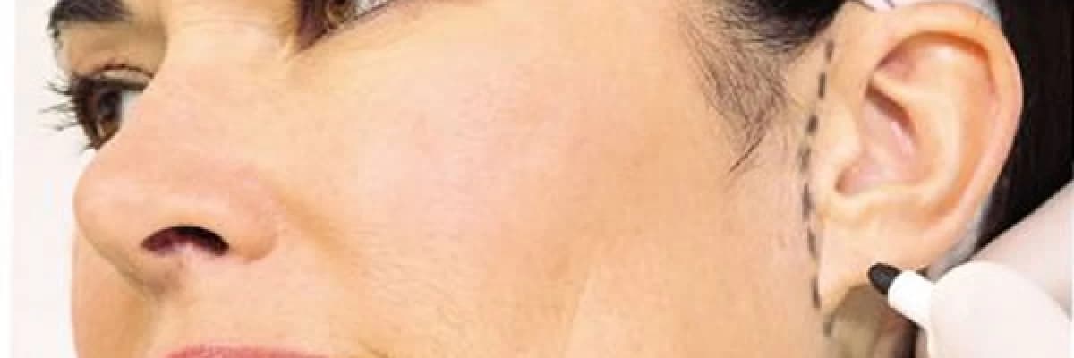 Kepçe Kulak Estetiği (Ameliyatsız İple Kulak Estetiği – Otoplasti)