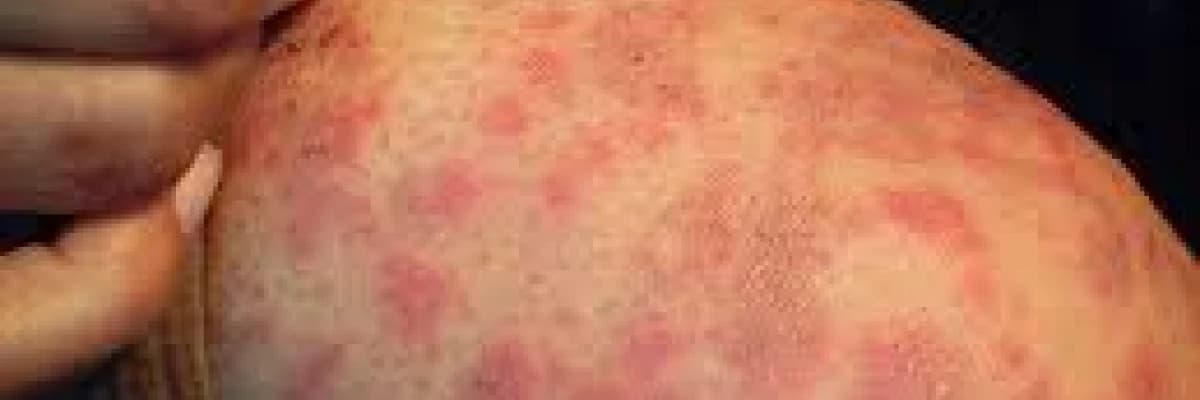 Biorezonans Metodu ile Alerji Tedavisi