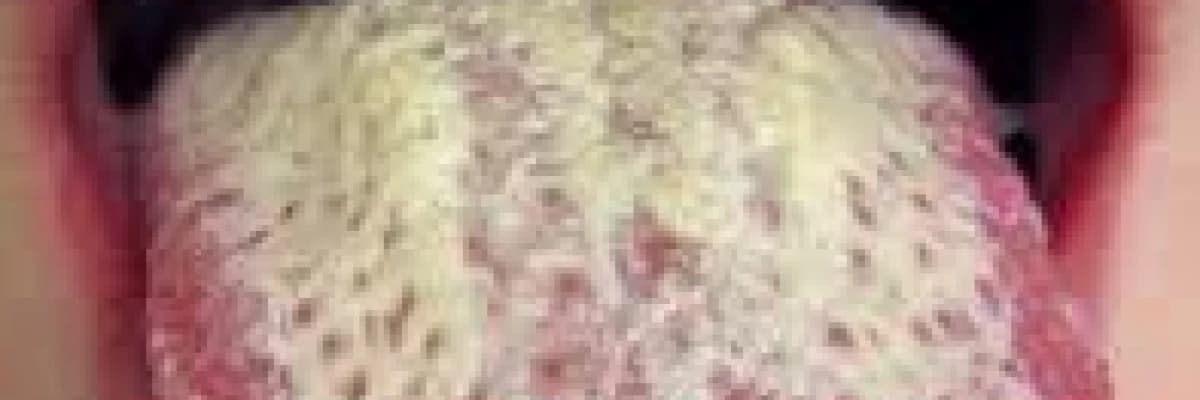 Kandida; bağışıklık sistemini zayıflatan barsak mantarı