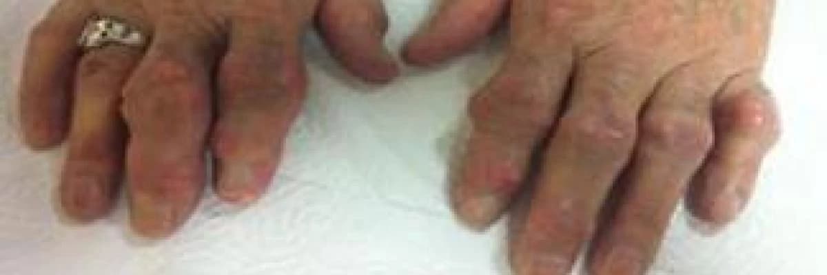 Gut hastalığı nedir ? Neler yasaktır ? Nasıl beslenilir ?