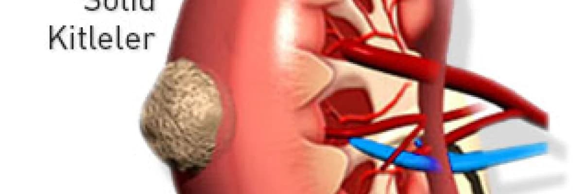 Böbrek Tümörleri ve Tedavisi