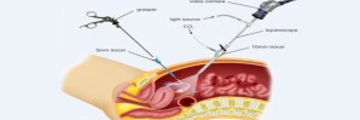 Laparoskopi Nedir? Laparoskopi Ne Zaman Yapılır?