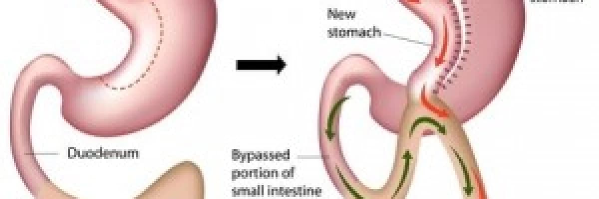 Mini Gastric Bypass Ameliyatı