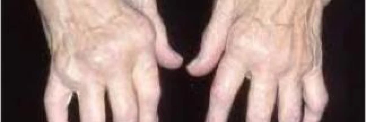 Romatoid Artrit ve Beslenme (Bağışıklığı güçlendiren yiyecekler)