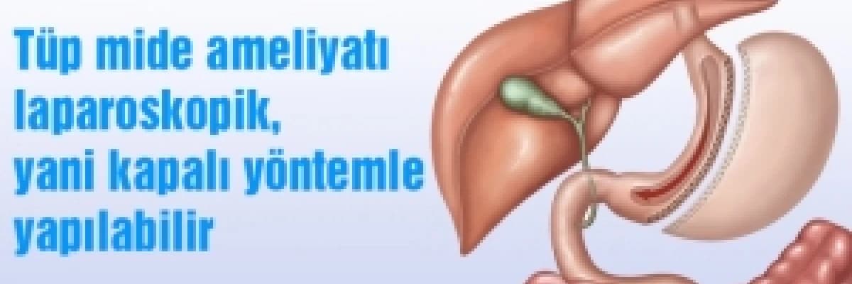 OBEZİTE (AŞIRI ŞİŞMANLIK )VE TÜP MİDE (SLEEVE GASTREKTOMİ )OPERASYONU