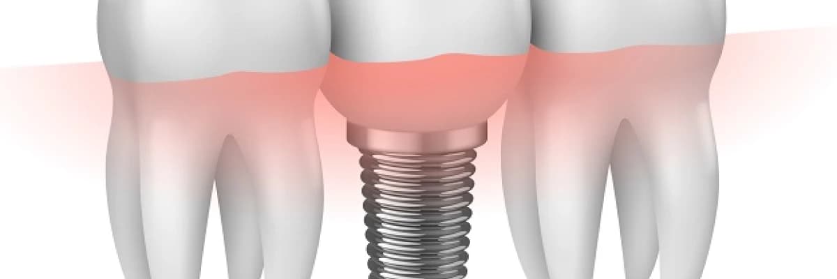 İmplant Tedavi Süresi Nasıldır