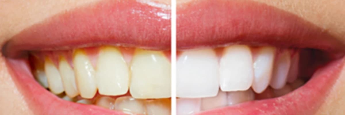 DİŞ BEYAZLATMA İLE İLGİLİ SIKÇA SORULAN SORULAR