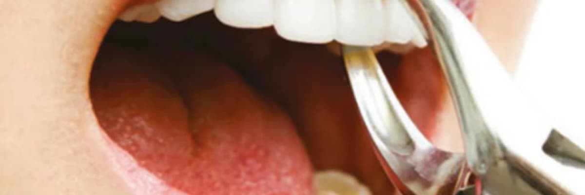 DİŞ ÇEKİMİ VE SONRASI hakkında merak edilenler