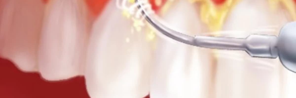 Diş Bakımı; DİŞLERİ TEMİZLETMEK ZARARLI MIDIR?