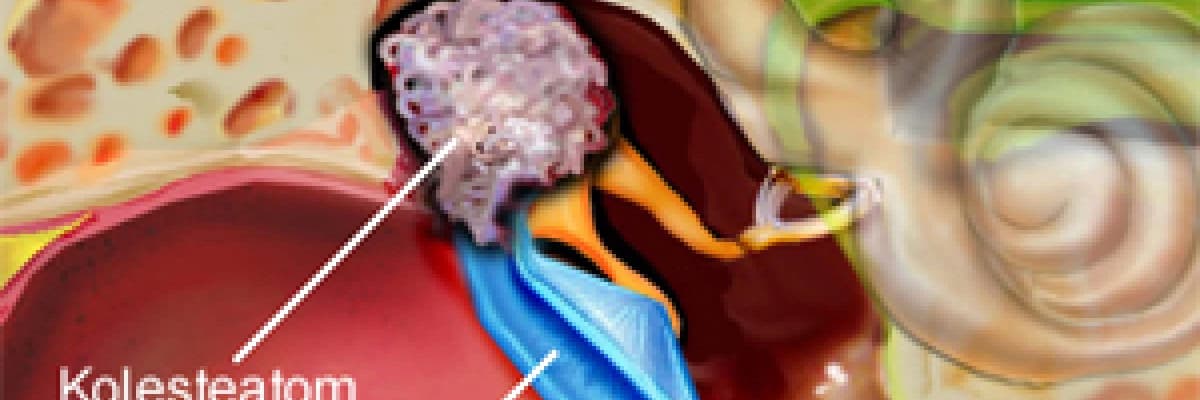 Kulak ZARI AMELİYATI - TİMPANOPLASTİ NEDİR?