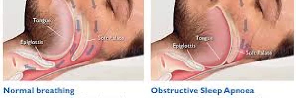 HORLAMA VE UYKU APNESİ AMELİYATI