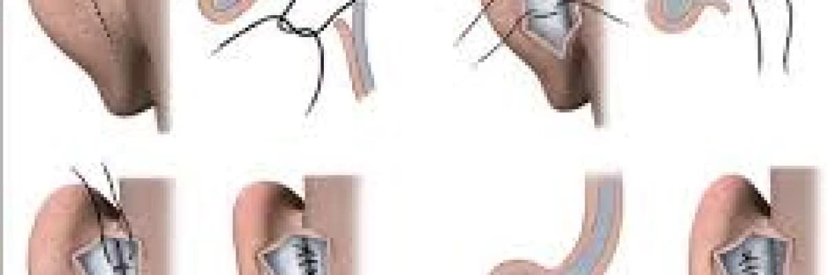 Otoplasti - Kepçe Kulak