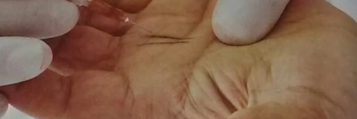 Parmakta tetiklenme nedir?