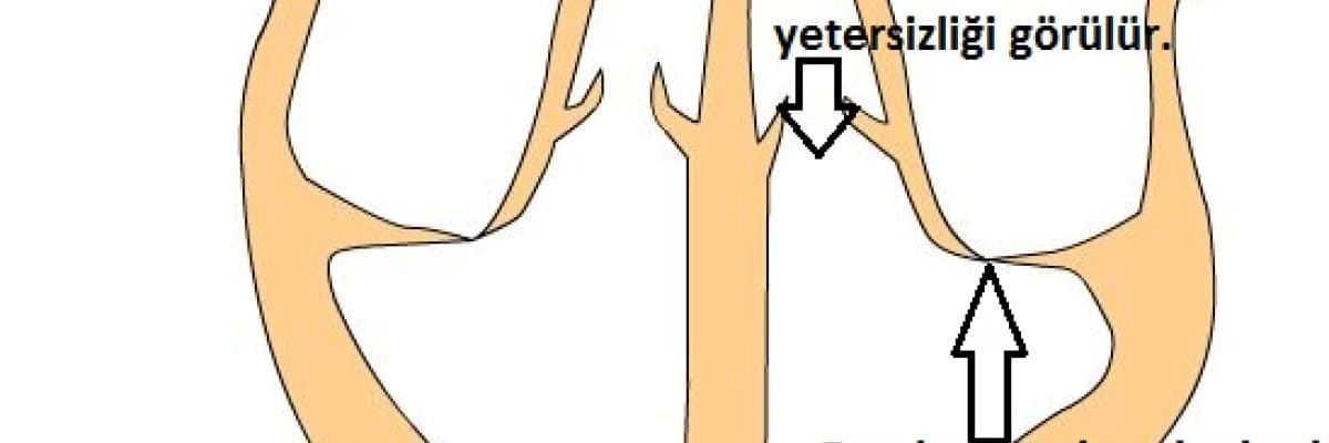 Akut romatizmal ateş nedir?