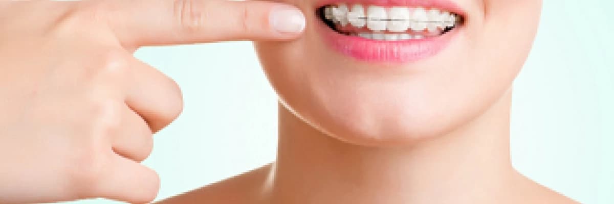 Şeffaf Diş Teli Tedavisi