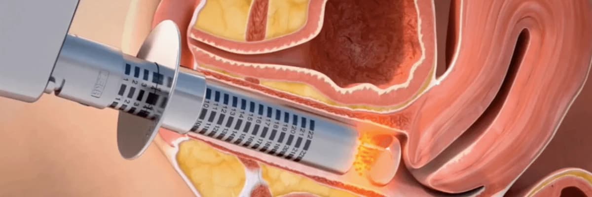 Lazerle Vajinal Daraltma