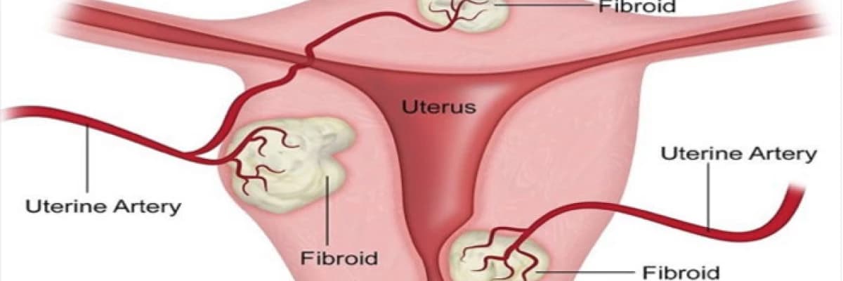 Miyomların tanı ve tedavisi hakkında